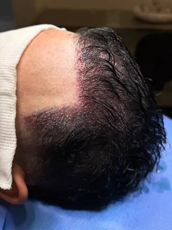 transplante capilar sem raspar